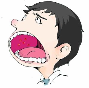 口腔溃疡治疗方法